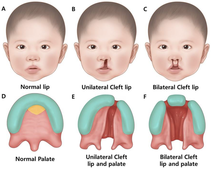 Cleft Palate & Lip